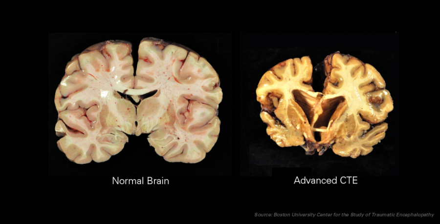 After the four principle stages of CTE take place, the human brain results in the brain on the right compared to that of a normal brain on the left. Photo credit: Ann McKee, MD, BU School of Medicine/VA Boston Healthcare System